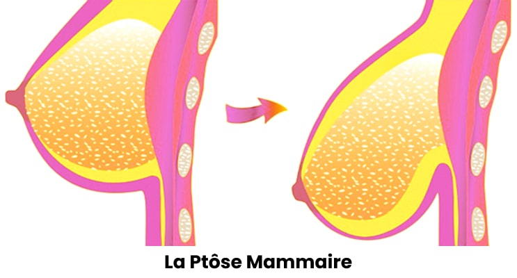 La Ptôse Mammaire