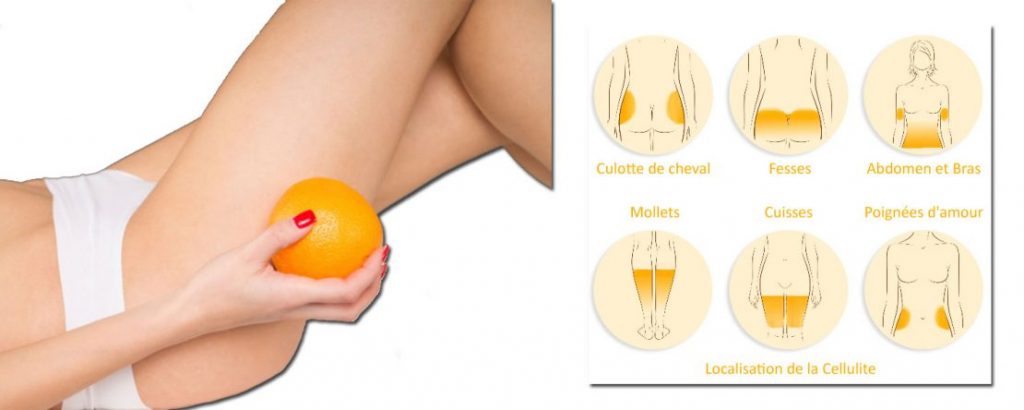 peau d'orange sellulite