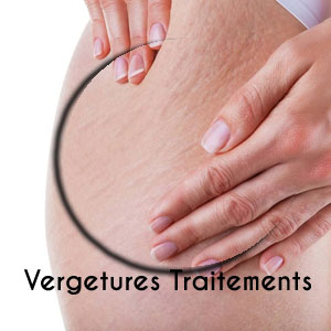 Traitement vergetures blanches Traitement vergetures blanches
