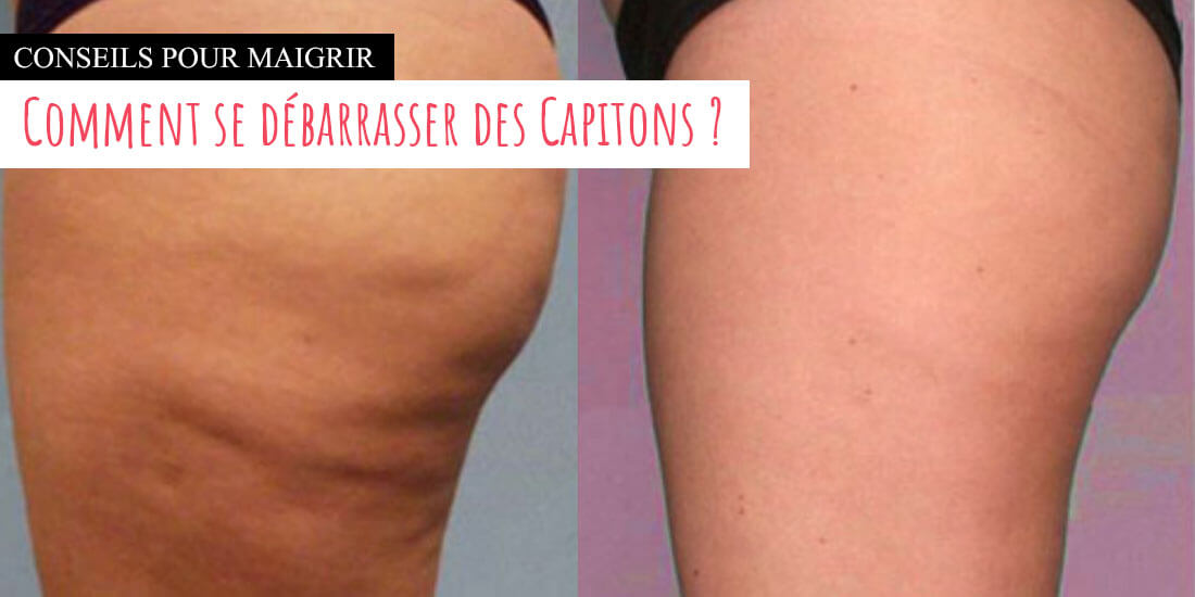 Comment se débarrasser des capitons Comment se débarrasser des capitons