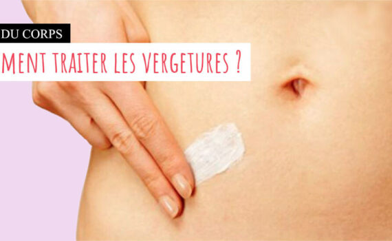 Vergetures: comment elles apparaissent, comment elles s'atténuent ?