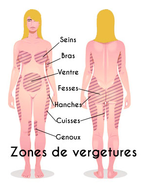 Zones des vergetures blanches Zones des vergetures blanches
