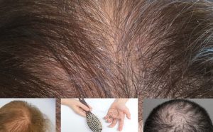Comment réduire la cavlitie et la chute du cheveux