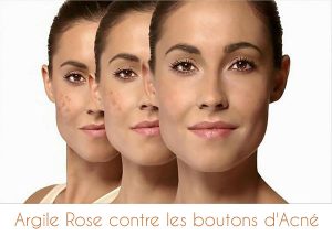 Argile rose pour traiter les boutons d'acné