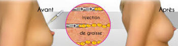 Lipofilling avant-après Lipofilling avant-après