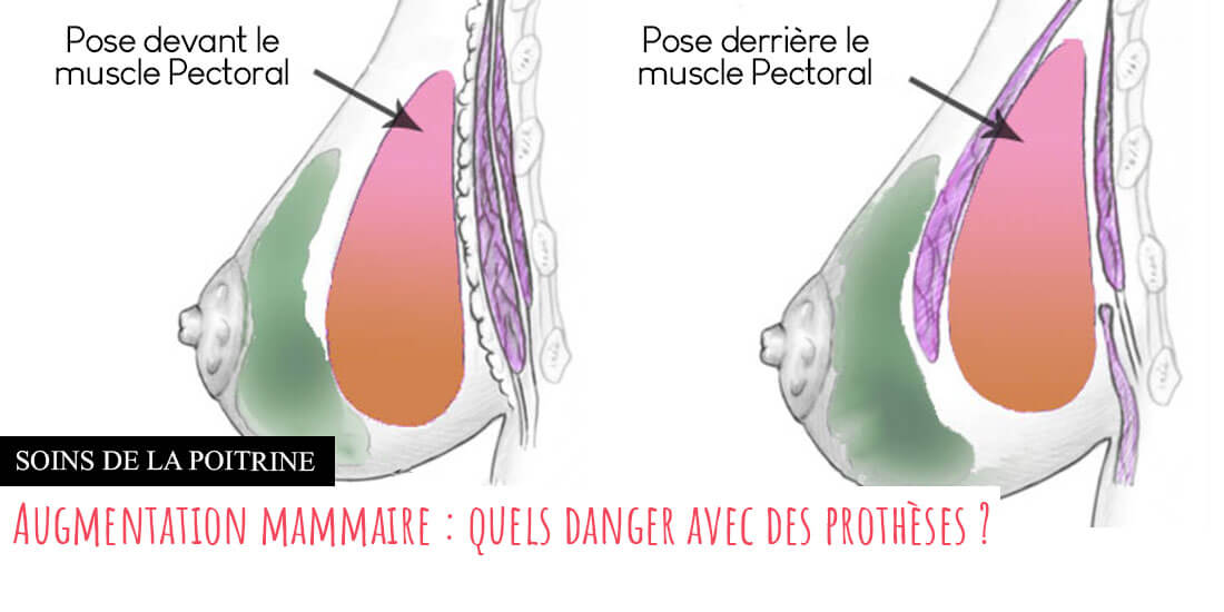 2 modes de poses des prothèses mammaires