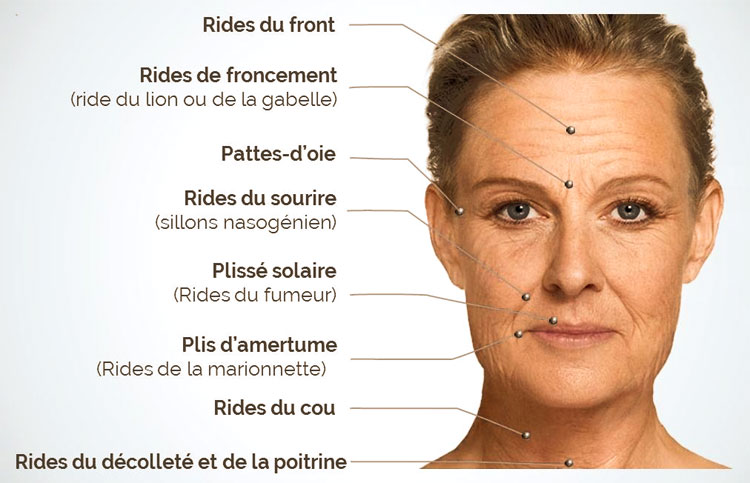 Comment s'appellent les rides du visage