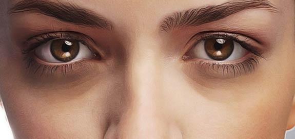Arnica, un remède contre les taches noires et les cernes sous les yeux