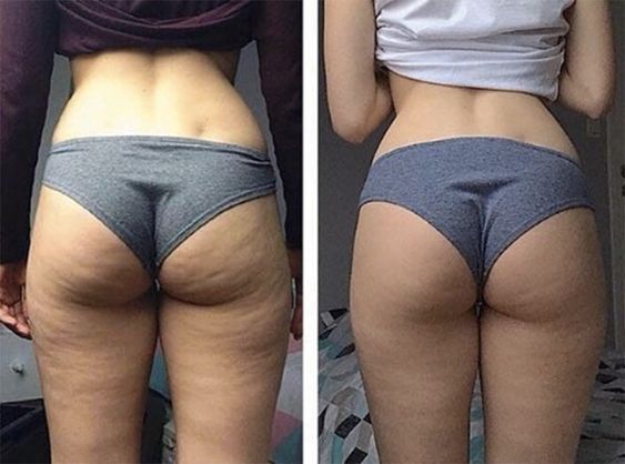 ventouse cellulite avant après Photo pinterest cellublue
